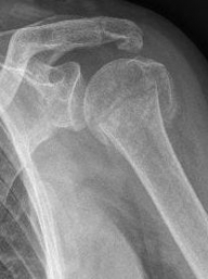 Proximaler Oberarmbruch4