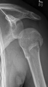 Proximaler Oberarmbruch7
