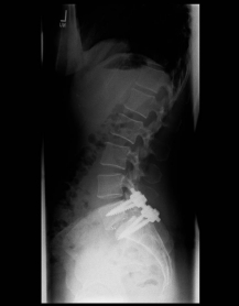 Spondylolisthese II